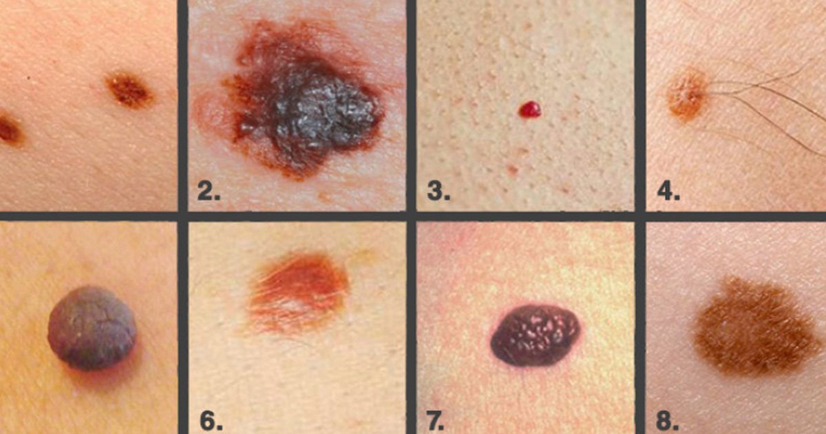 Here Is The Brilliant Guide To Identify And Prevent Skin Cancer Born