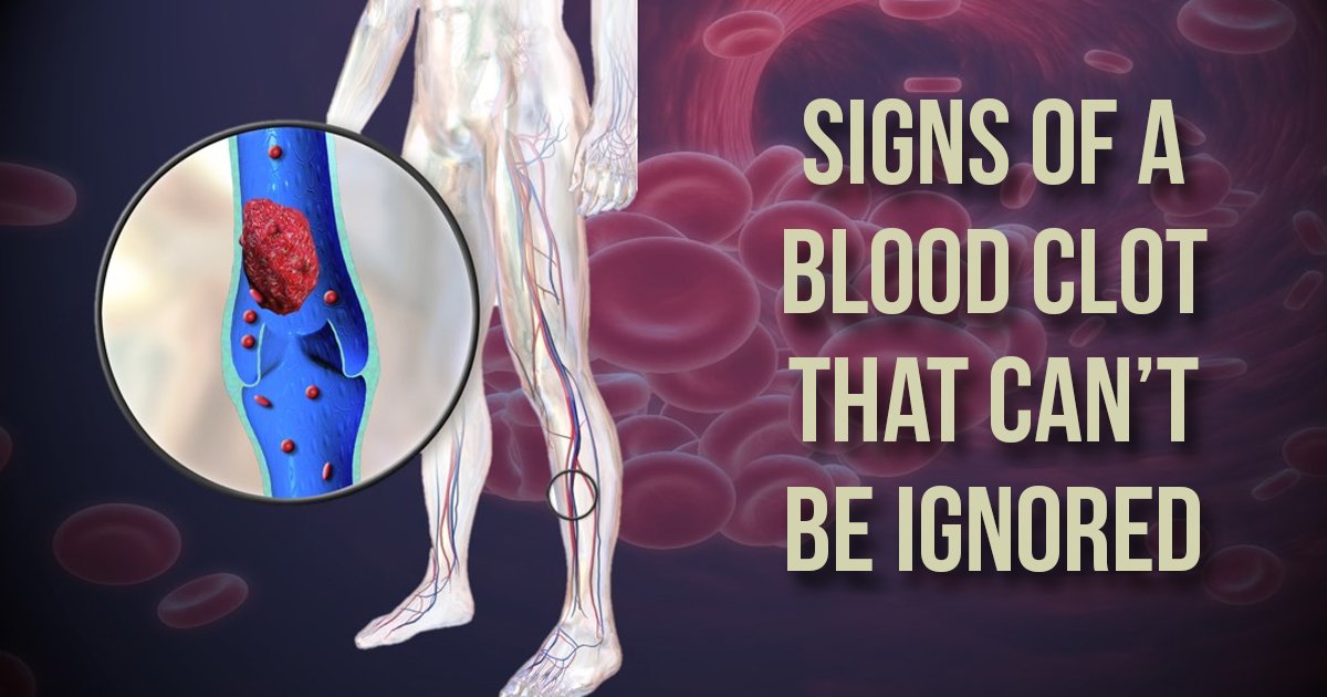 10 Signs Of Blood Clot